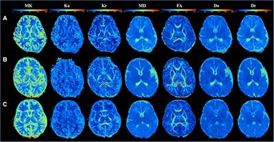 Application of diffusion kurtosis imaging in neonatal brain development